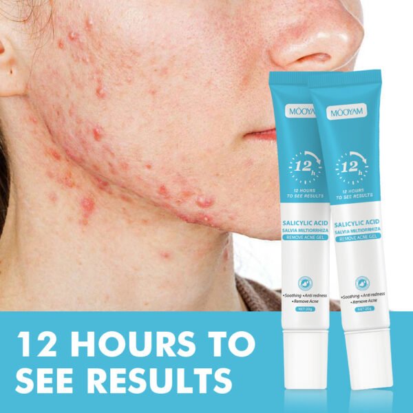 MOOYAM Salicylic Acid Anti-Acne Cream Lightens Acne Scars, Removes Blackheads, Closes Pores, Shrinks Pores, Plant Essence Anti-Acne Gel Manufacturer Wholesale Private Label OEM
