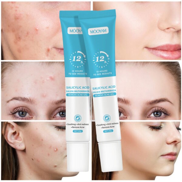 MOOYAM Salicylic Acid Anti-Acne Cream Lightens Acne Scars, Removes Blackheads, Closes Pores, Shrinks Pores, Plant Essence Anti-Acne Gel Manufacturer Wholesale Private Label OEM - Image 3