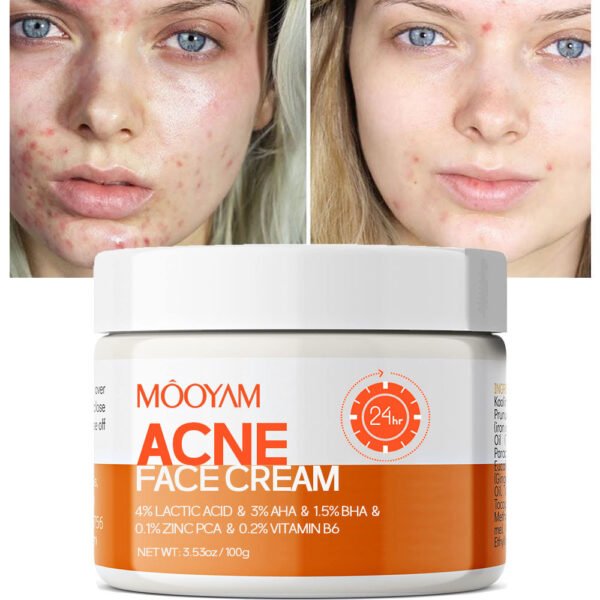 MOOYAM Anti-acne Cream Acne Remover Lightens Acne Scars Closed Comedones Repair Anti-acne Cream Manufacturer Wholesale OEM Private Label
