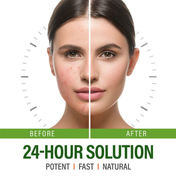 MOOYAM Anti-acne Cream Acne Remover Lightens Acne Scars Closed Comedones Repair Anti-acne Cream Manufacturer Wholesale OEM Private Label - Image 4